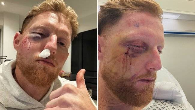 Stokes gets face fixed